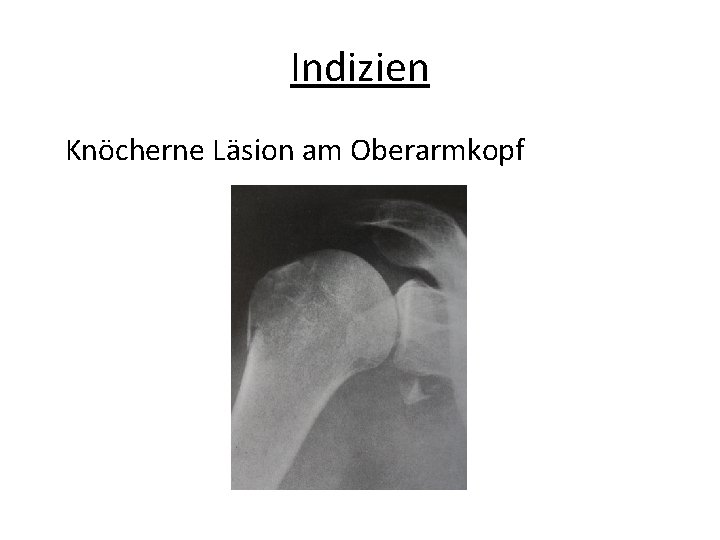 Indizien Knöcherne Läsion am Oberarmkopf 