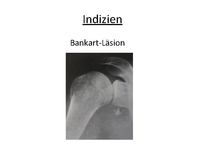 Indizien Bankart-Läsion 