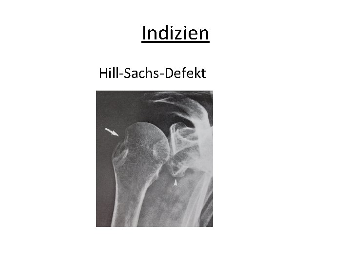 Indizien Hill-Sachs-Defekt 