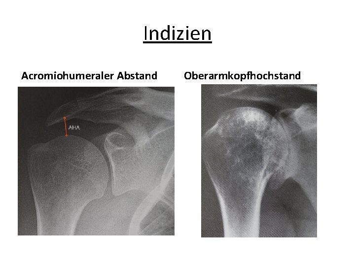 Indizien Acromiohumeraler Abstand Oberarmkopfhochstand 