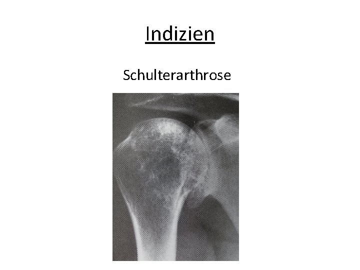 Indizien Schulterarthrose 