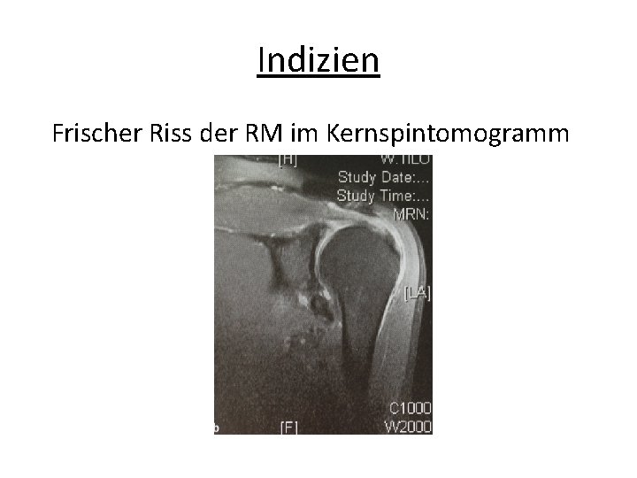 Indizien Frischer Riss der RM im Kernspintomogramm 