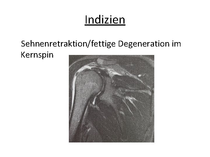 Indizien Sehnenretraktion/fettige Degeneration im Kernspin 