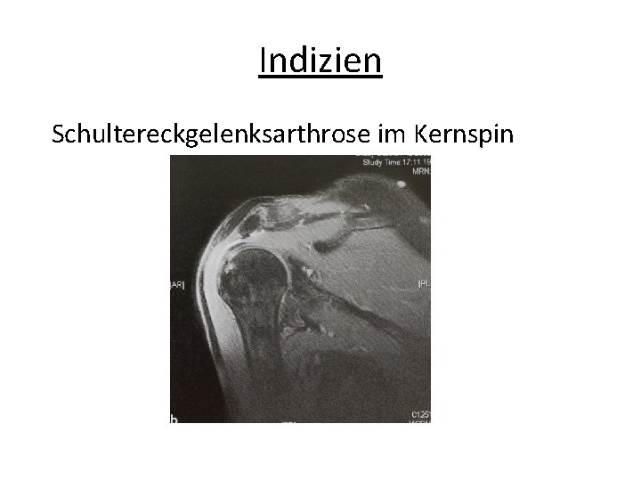 Indizien Schultereckgelenksarthrose im Kernspin 