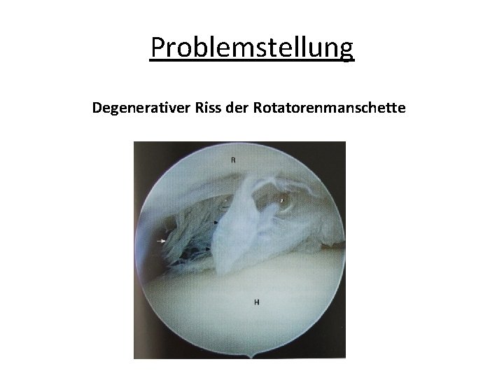 Problemstellung Degenerativer Riss der Rotatorenmanschette 