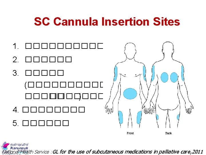 SC Cannula Insertion Sites 1. ������� 2. ������ 3. ����� (�������� ) 4. ����