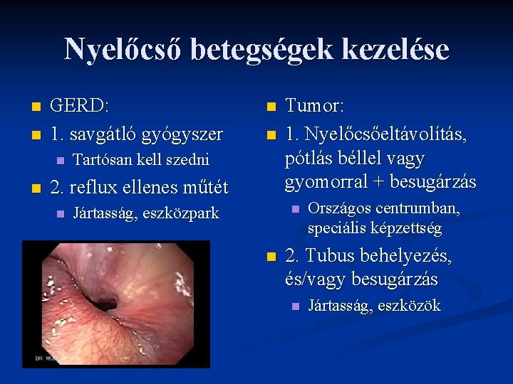 Nyelőcső betegségek kezelése n n GERD: 1. savgátló gyógyszer n n Tartósan kell szedni