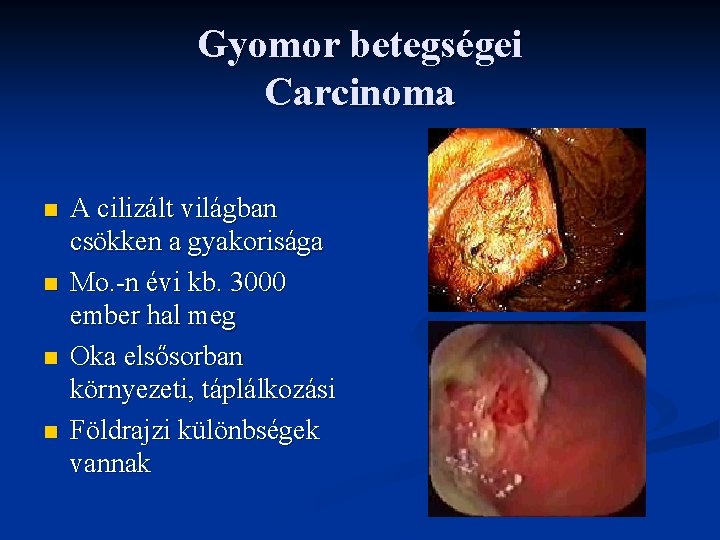 Gyomor betegségei Carcinoma n n A cilizált világban csökken a gyakorisága Mo. -n évi