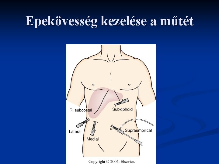 Epekövesség kezelése a műtét Epekövesség kezelése a műtét