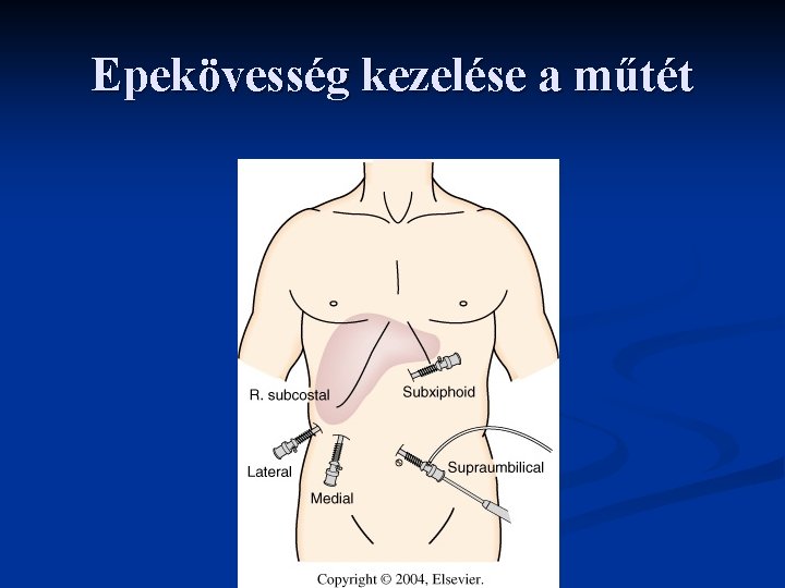 Epekövesség kezelése a műtét 