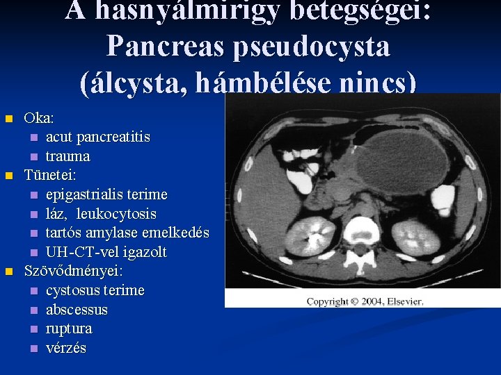 A hasnyálmirigy betegségei: Pancreas pseudocysta (álcysta, hámbélése nincs) n n n Oka: n acut