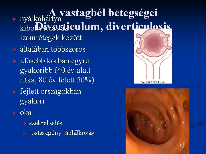 A vastagbél betegségei Ø nyálkahártya Diverticulum , diverticulosis kiboltosulás az Ø Ø izomrétegek között A vastagbél betegségei Ø nyálkahártya Diverticulum , diverticulosis kiboltosulás az Ø Ø izomrétegek között