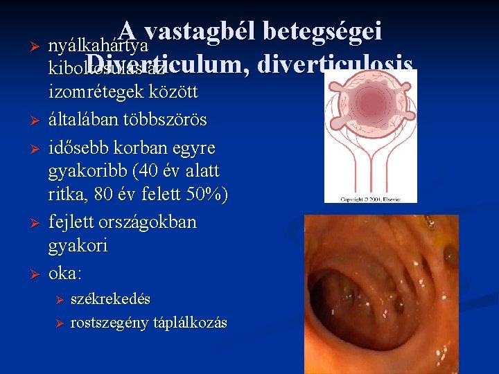 A vastagbél betegségei Ø nyálkahártya Diverticulum , diverticulosis kiboltosulás az Ø Ø izomrétegek között