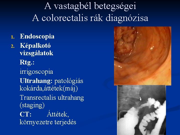 A vastagbél betegségei A colorectalis rák diagnózisa 1. 2. Endoscopia Képalkotó vizsgálatok Rtg. : A vastagbél betegségei A colorectalis rák diagnózisa 1. 2. Endoscopia Képalkotó vizsgálatok Rtg. :