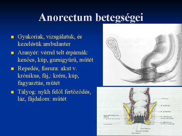 Anorectum betegségei n n Gyakoriak, vizsgálatuk, és kezelésük ambulanter Aranyér: vérrel telt érpárnák: kenőcs,