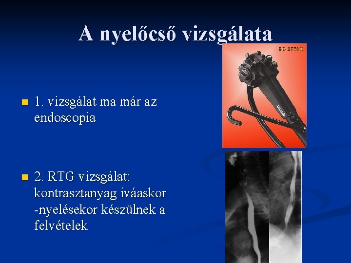 A nyelőcső vizsgálata n 1. vizsgálat ma már az endoscopia n 2. RTG vizsgálat: A nyelőcső vizsgálata n 1. vizsgálat ma már az endoscopia n 2. RTG vizsgálat: