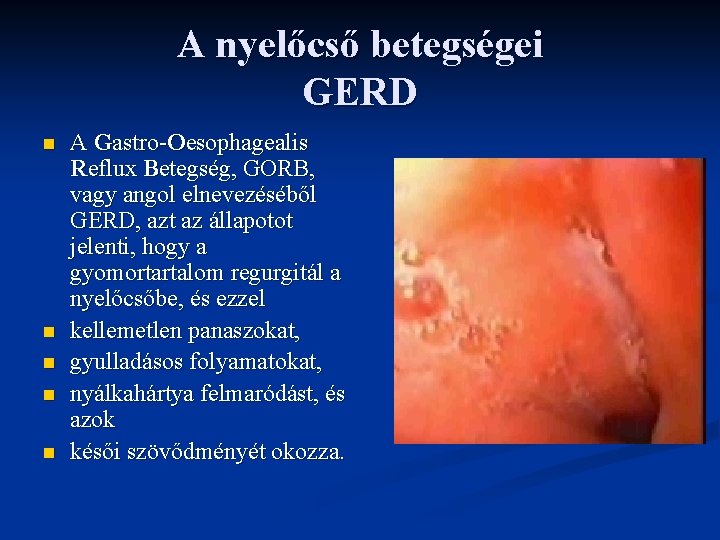 A nyelőcső betegségei GERD n n n A Gastro-Oesophagealis Reflux Betegség, GORB, vagy angol