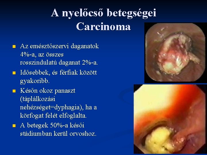 A nyelőcső betegségei Carcinoma n n Az emésztőszervi daganatok 4%-a, az összes rosszindulatú daganat