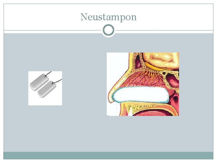 Neustampon 