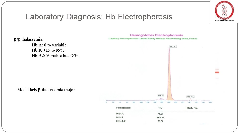 Laboratory Diagnosis: Hb Electrophoresis β/β thalassemia: Hb A: 0 to variable Hb F: >15