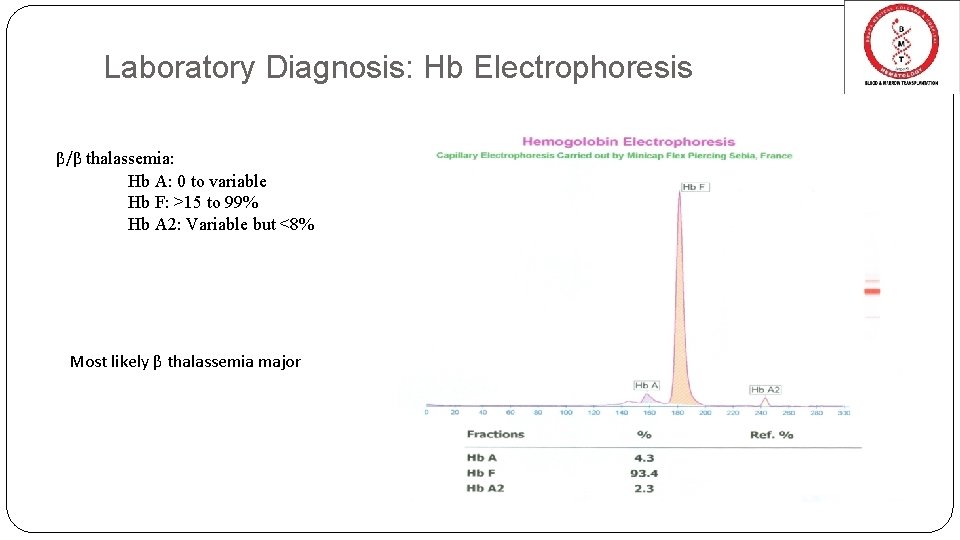 Laboratory Diagnosis: Hb Electrophoresis β/β thalassemia: Hb A: 0 to variable Hb F: >15 Laboratory Diagnosis: Hb Electrophoresis β/β thalassemia: Hb A: 0 to variable Hb F: >15