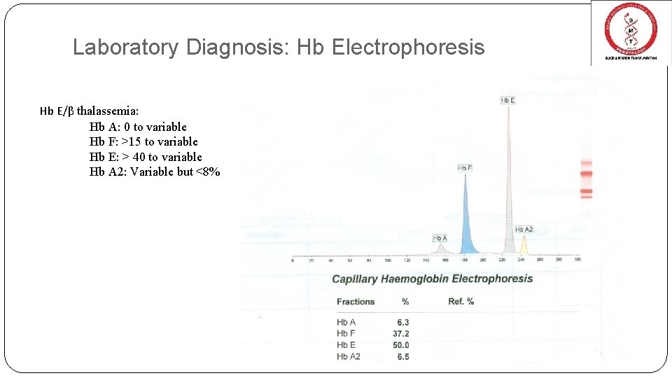 Laboratory Diagnosis: Hb Electrophoresis Hb E/β thalassemia: Hb A: 0 to variable Hb F:
