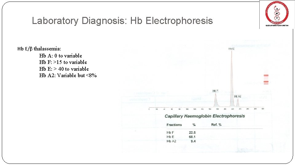 Laboratory Diagnosis: Hb Electrophoresis Hb E/β thalassemia: Hb A: 0 to variable Hb F: Laboratory Diagnosis: Hb Electrophoresis Hb E/β thalassemia: Hb A: 0 to variable Hb F: