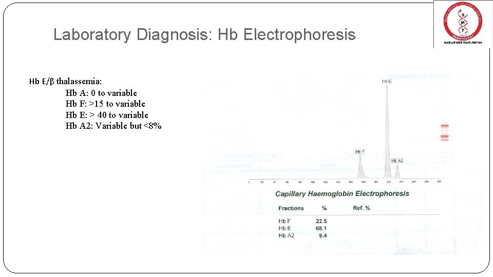 Laboratory Diagnosis: Hb Electrophoresis Hb E/β thalassemia: Hb A: 0 to variable Hb F: