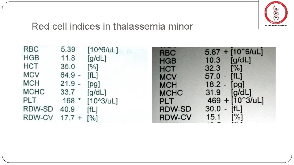 Red cell indices in thalassemia minor 