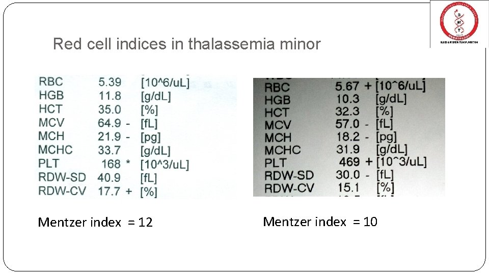 Red cell indices in thalassemia minor Mentzer index = 12 Mentzer index = 10