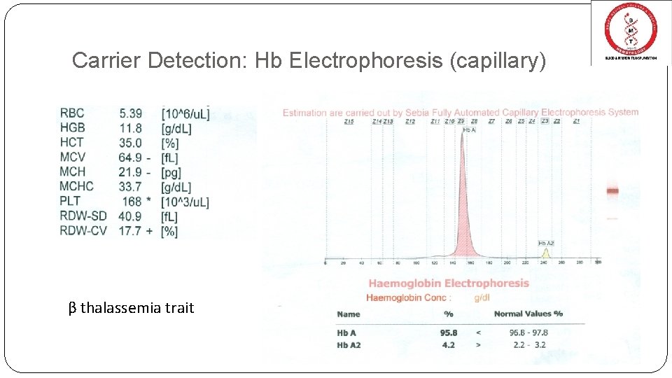 Carrier Detection: Hb Electrophoresis (capillary) β thalassemia trait 