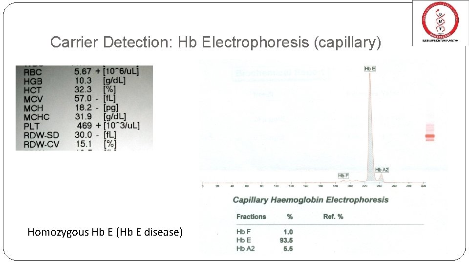 Carrier Detection: Hb Electrophoresis (capillary) Homozygous Hb E (Hb E disease) Carrier Detection: Hb Electrophoresis (capillary) Homozygous Hb E (Hb E disease)