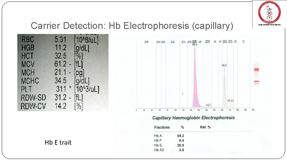 Carrier Detection: Hb Electrophoresis (capillary) Hb E trait Carrier Detection: Hb Electrophoresis (capillary) Hb E trait