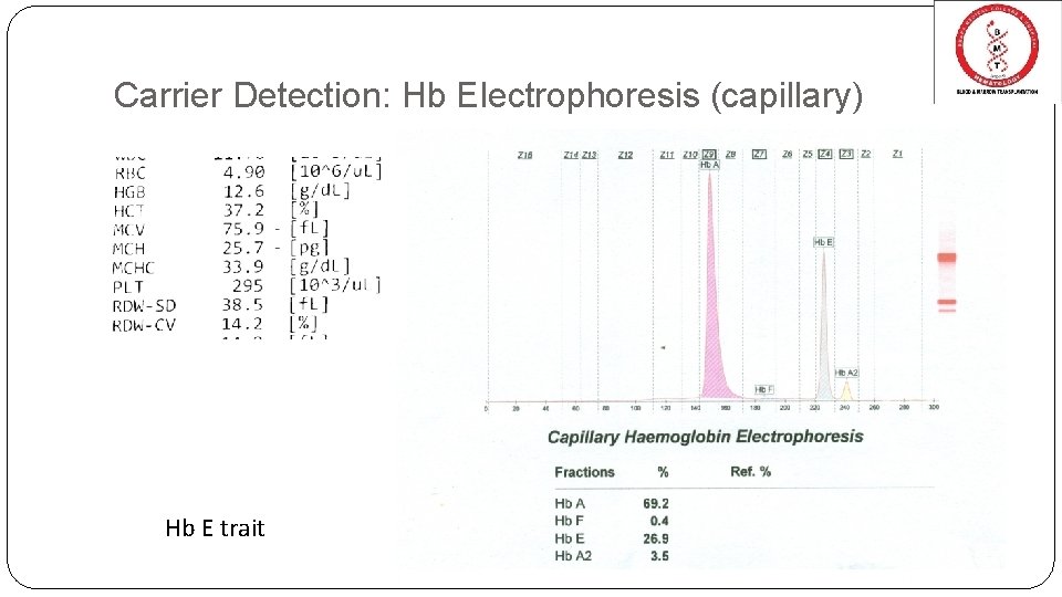 Carrier Detection: Hb Electrophoresis (capillary) Hb E trait 