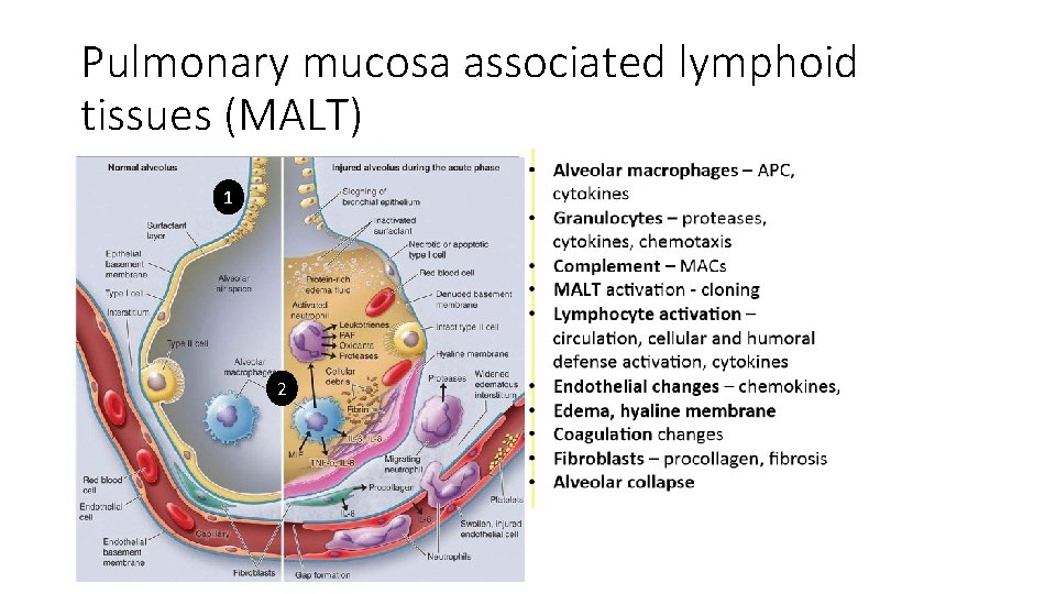 Pulmonary mucosa associated lymphoid tissues (MALT) 1 2 