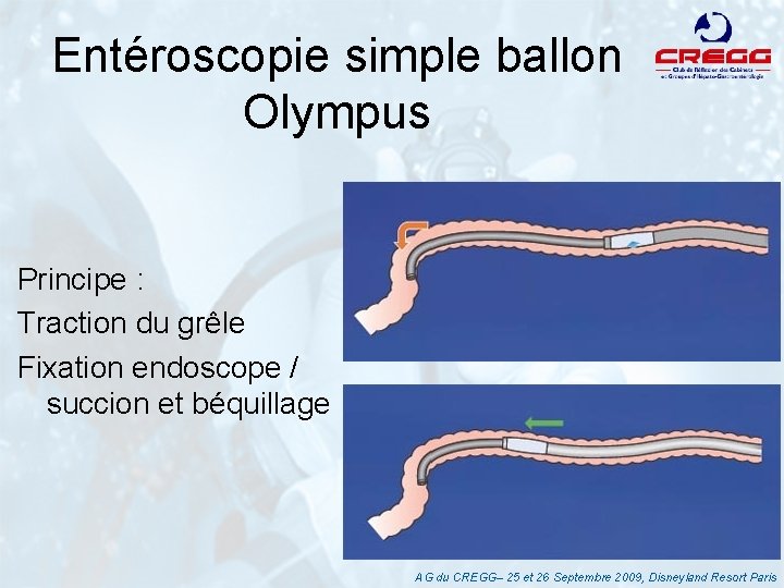Entéroscopie simple ballon Olympus Principe : Traction du grêle Fixation endoscope / succion et