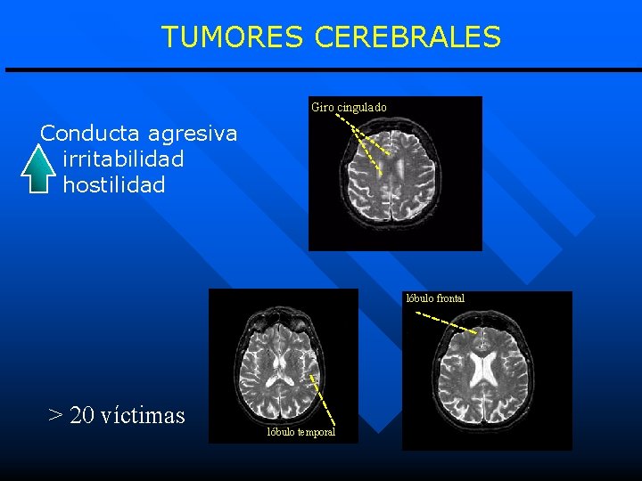 TUMORES CEREBRALES Giro cingulado Conducta agresiva irritabilidad hostilidad lóbulo frontal > 20 víctimas lóbulo