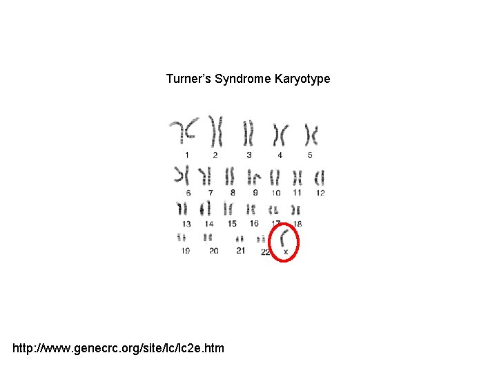 Turner’s Syndrome Karyotype http: //www. genecrc. org/site/lc/lc 2 e. htm 