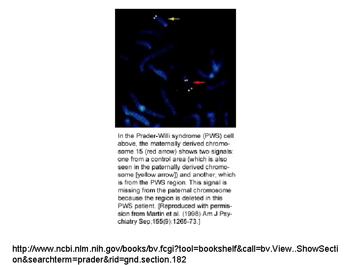 http: //www. ncbi. nlm. nih. gov/books/bv. fcgi? tool=bookshelf&call=bv. View. . Show. Secti on&searchterm=prader&rid=gnd. section.