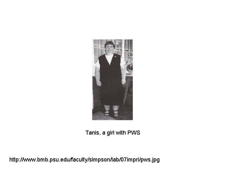 Tanis, a girl with PWS http: //www. bmb. psu. edu/faculty/simpson/lab/07 impri/pws. jpg 