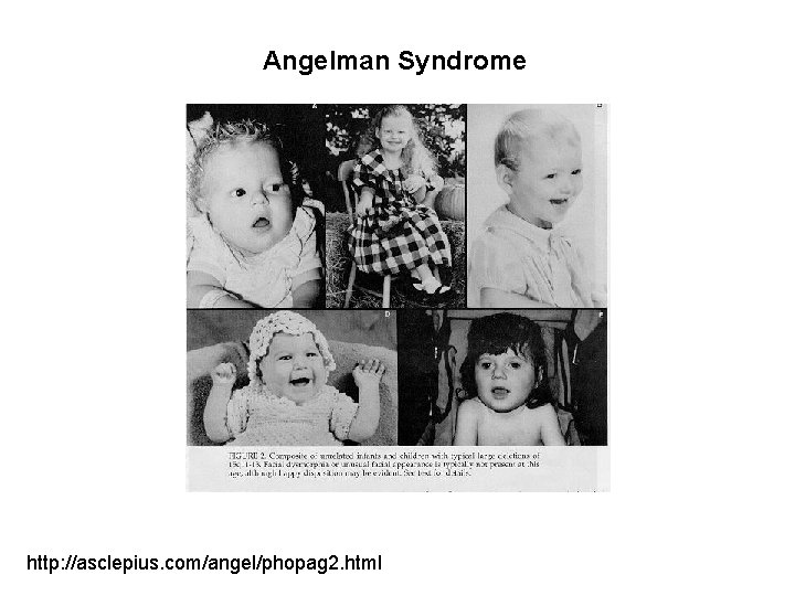 Angelman Syndrome http: //asclepius. com/angel/phopag 2. html 