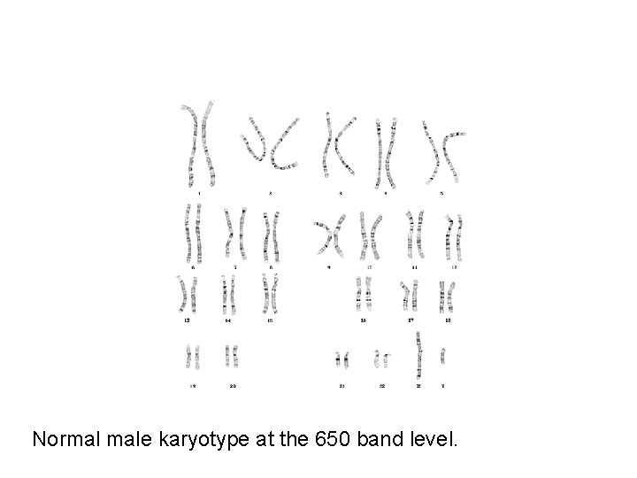 Normal male karyotype at the 650 band level. 