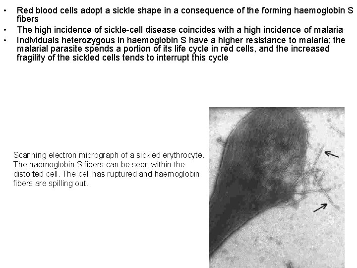  • • • Red blood cells adopt a sickle shape in a consequence