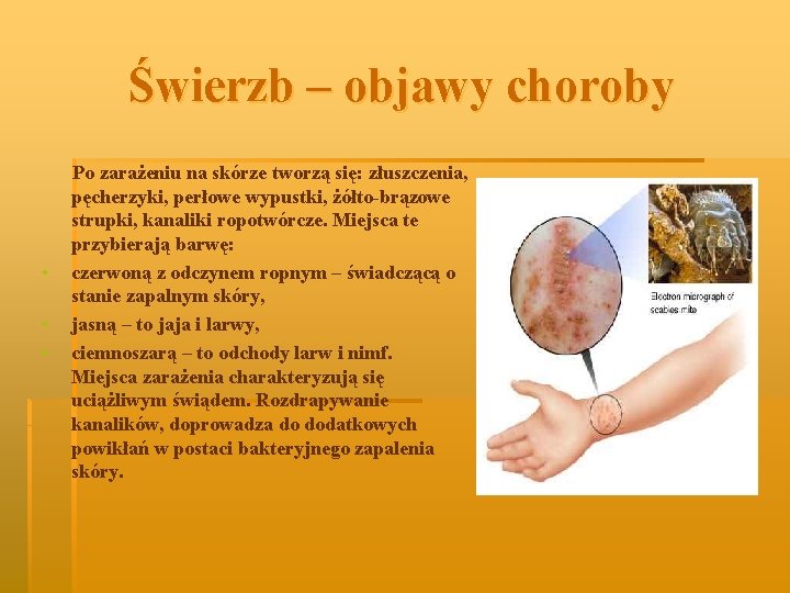 Świerzb – objawy choroby • • • Po zarażeniu na skórze tworzą się: złuszczenia,