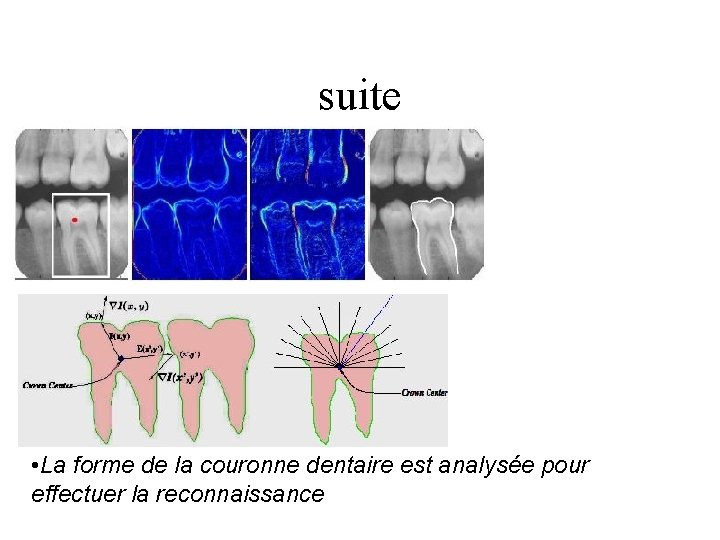 suite • La forme de la couronne dentaire est analysée pour effectuer la reconnaissance