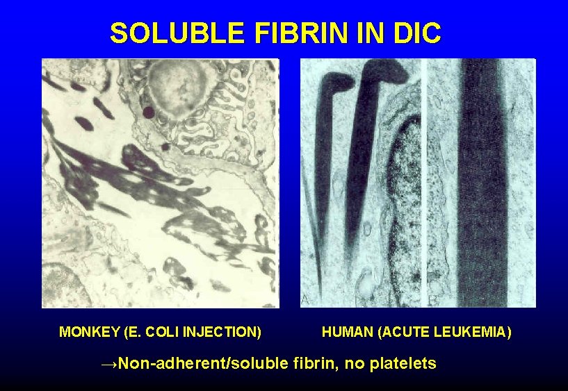 SOLUBLE FIBRIN IN DIC MONKEY (E. COLI INJECTION) HUMAN (ACUTE LEUKEMIA) →Non-adherent/soluble fibrin, no