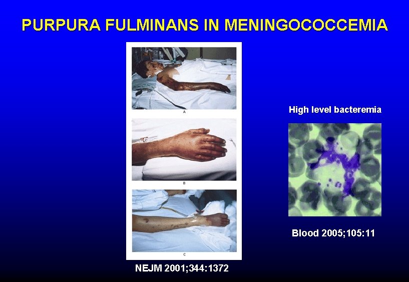 PURPURA FULMINANS IN MENINGOCOCCEMIA High level bacteremia Blood 2005; 105: 11 NEJM 2001; 344: