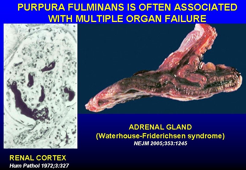 PURPURA FULMINANS IS OFTEN ASSOCIATED WITH MULTIPLE ORGAN FAILURE ADRENAL GLAND (Waterhouse-Friderichsen syndrome) NEJM