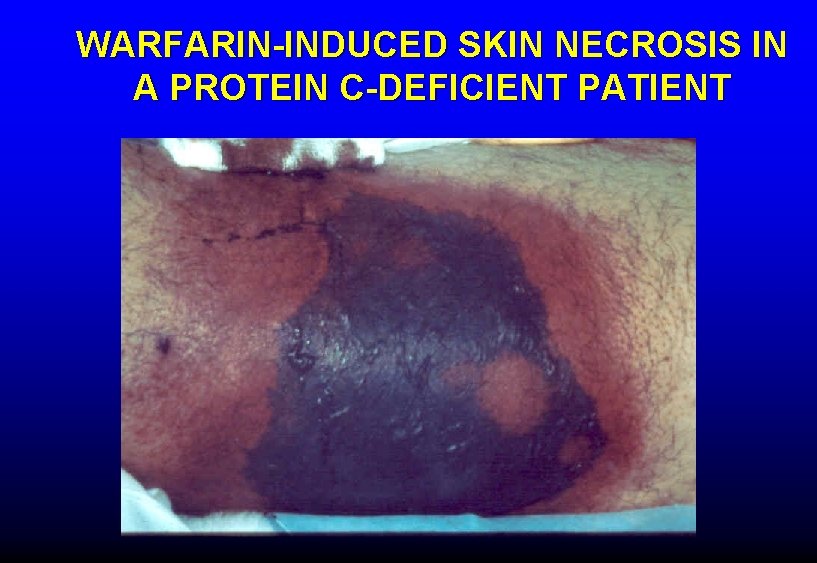 WARFARIN-INDUCED SKIN NECROSIS IN A PROTEIN C-DEFICIENT PATIENT 