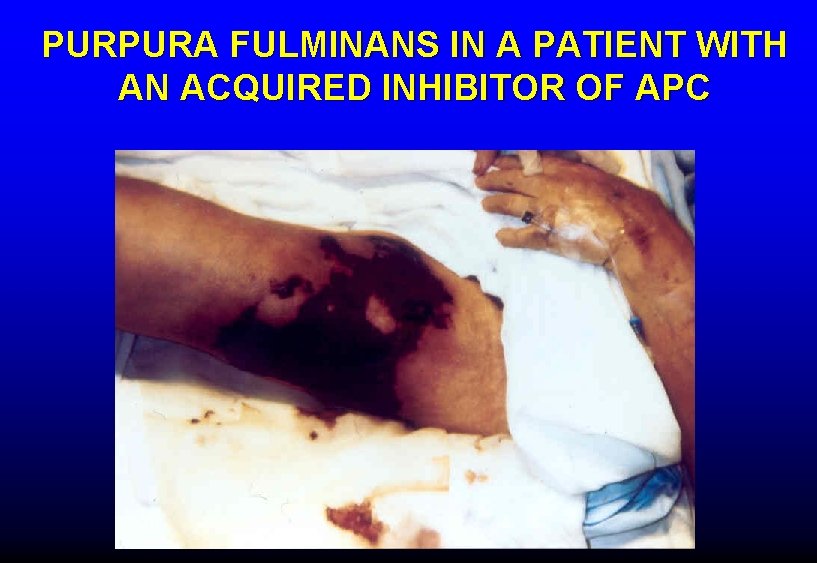 PURPURA FULMINANS IN A PATIENT WITH AN ACQUIRED INHIBITOR OF APC 